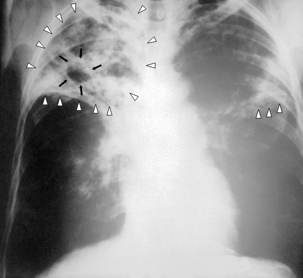 Fogyás tuberkulózis
